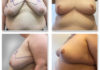 plas pier 10reduc 100x70 - Operacje plastyczne piersi
