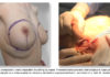 plas pier 15Aquafilling 100x70 - Operacje plastyczne piersi